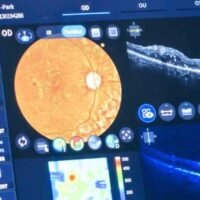 Digital Subtraction Angiography (DSA)