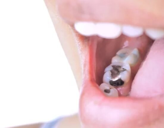 Amalgam Fillings