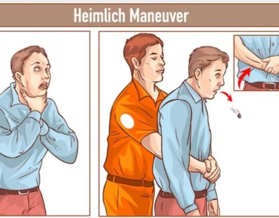 Heimlich Maneuver